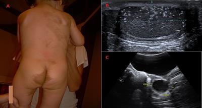 Auxological and Endocrinological Features in Children With McCune Albright Syndrome: A Review